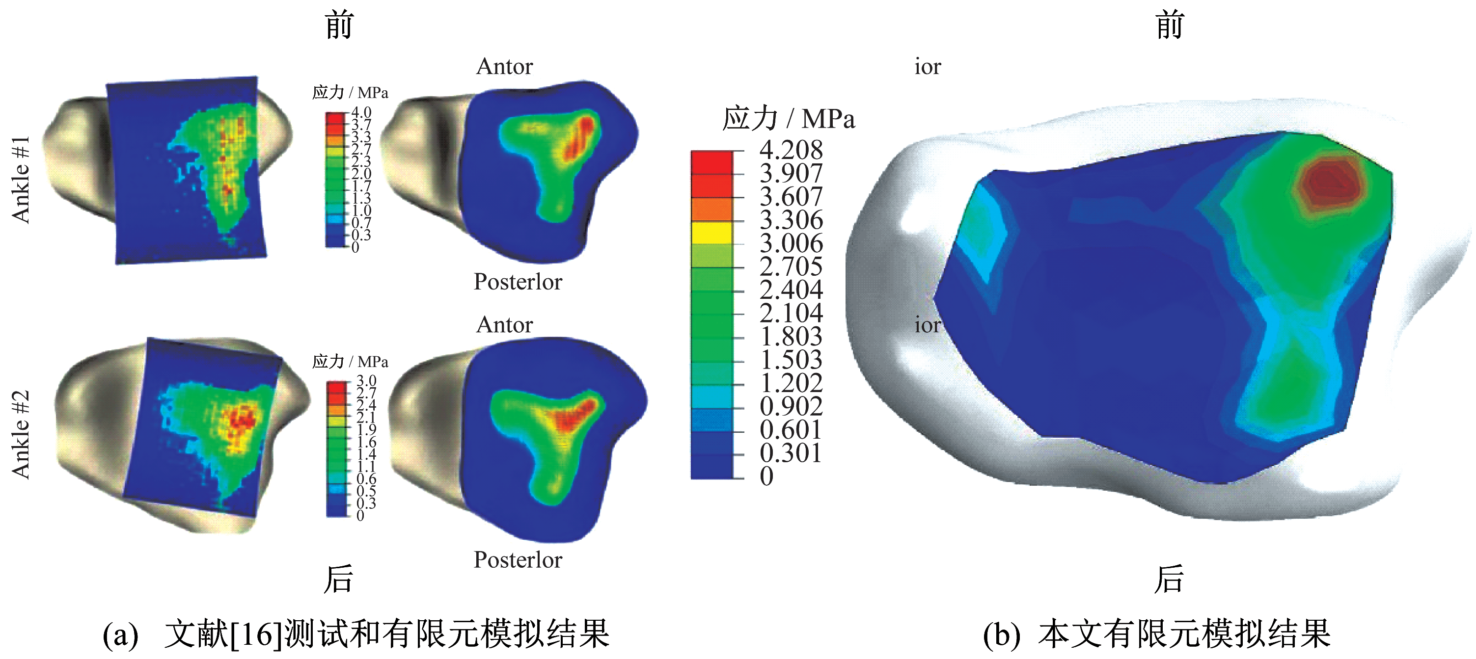不同触地模式慢跑的足踝有限元分析 不同触地模式慢跑的足踝有限元分析